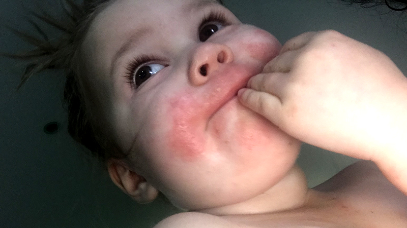 Baby Poppy's eczema affected her face too.